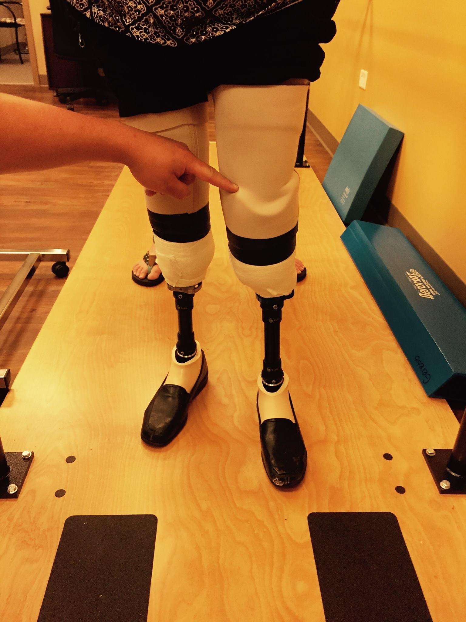 cost price below knee prosthetic leg suction