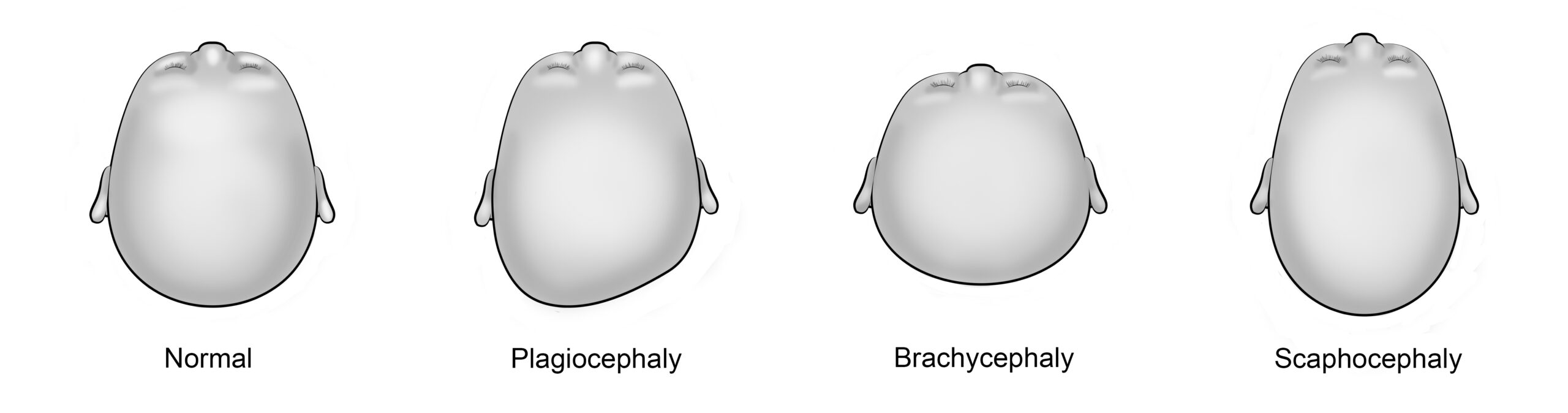 reshape baby head