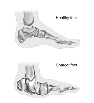 foot charcot